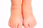7 biện pháp tự nhiên giúp điều trị phù nề