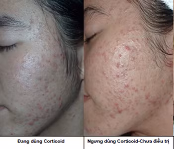 Ngoài ra, corticoid chống chỉ định với bệnh nhân nhiễm nấm toàn thân và quá mẫn cảm với thuốc. Đặc biệt chú ý sử dụng thận trọng khi thật cần thiết đối với phụ nữ mang thai và cho con bú vì thuốc có thể truyền qua nhau thai và bài tiết qua sữa. Xem thêm: Những cặp sinh đôi dính liền kỳ lạ nhất thế giới.