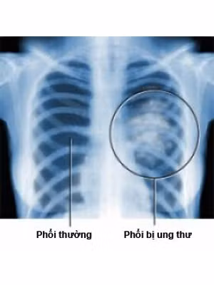 Cảnh báo nhầm lẫn: Viêm phổi. Trên phim chụp Xquang phổi, cả viêm phổi và khối u phổi đều có màu trắng. Viêm phổi sẽ khỏi nhưng sau 4-6 tuần, bạn vẫn cần chụp Xquang lại để kiểm tra. Xét nghiệm: Sinh thiết. Xem thêm:Những thực phẩm không thể "kết đôi" cùng thịt lợn