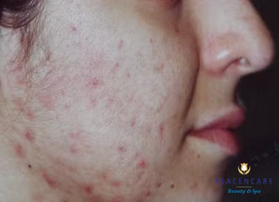 Mụn không nguy hiểm: Loại mụn này bạn có thể tự chữa trị bằng các phương pháp đơn giản. Thậm chí, các chuyên gia còn khuyên "mặc kệ" vì chúng sẽ nhanh chóng lành lặn, trả lại cho bạn một khuôn mặt hoàn hảo. (Ảnh chỉ mang tính chất minh họa) Xem thêm: Phóng viên, BTV và MC thường dùng thực phẩm gì để giữ giọng?