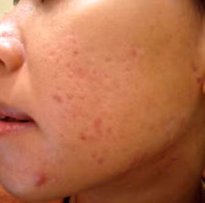 Điều trị mụn đầu trắng cũng không khó, các bạn có thể tự làm và đắp các loại mặt nạ như: bơ , trứng gà và mật ong, bạc hà... để xử lý chúng hiểu quả. Mỗi ngày một lần vào buổi tối, mỗi lần khoảng 15 phút là trên da bạn sẽ hoàn toàn biến mất mụn đầu trắng. (Ảnh chỉ mang tính chất minh họa) Xem thêm: Phóng viên, BTV và MC thường dùng thực phẩm gì để giữ giọng?