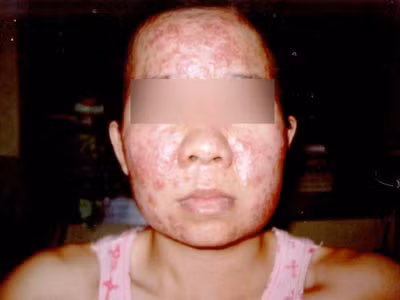 Mụn nang: Mụn nang là những nốt mụn ăn sâu trong da, chứa đầy mủ, gây đau đớn và thường để lại sẹo. Mụn nang có cấu tạo gần giống với mụn bọc. Chúng lan trên bề mặt da và làm tổn thương các tế bào da khỏe mạnh và phá hủy nang lông. (Ảnh chỉ mang tính chất minh họa) Xem thêm: Phóng viên, BTV và MC thường dùng thực phẩm gì để giữ giọng?