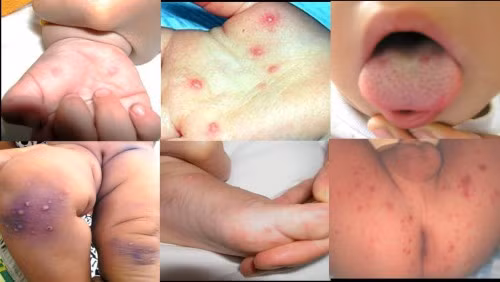 Bệnh tay chân miệng: Bệnh TCM lây qua dịch tiết mũi họng của trẻ bắn trực tiếp qua trẻ khác nếu tiếp xúc gần hoặc dính lên tay chân của trẻ khác, sau đó dùng tay đưa thức ăn vào miệng. Xem thêm: Bí quyết "nhỏ", giữ sức khỏe "lớn" trong mùa nắng nóng