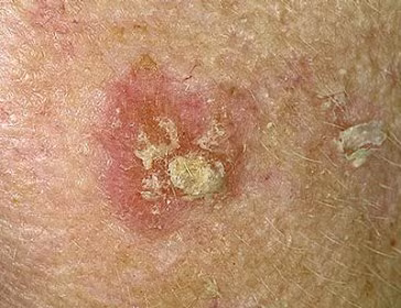 Vì vậy, khi thấy có hiện tượng mẩn ngứa hoặc viêm da, phải đi khám ngay ở các bệnh viện chuyên môn. Xem thêm: Bí quyết "nhỏ", giữ sức khỏe "lớn" trong mùa nắng nóng