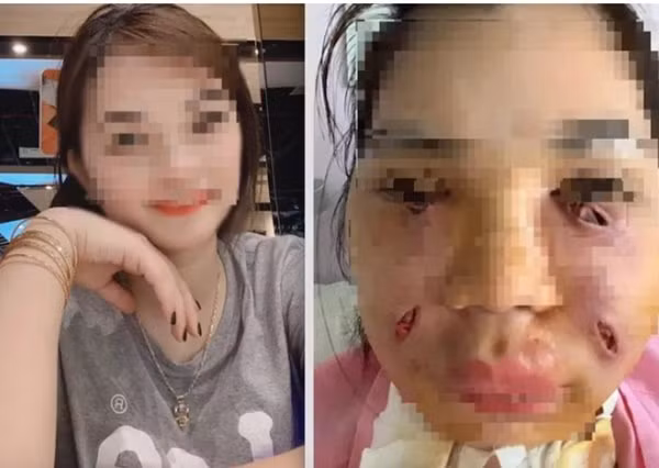 Hình ảnh cô Nguyễn Thị H. trước và sau khi bị nhiễm trùng khi thực hiện "tiêm mỡ tự thân". (Ảnh: Giadinhvietnam.com)