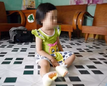 Một bé gái 3 tuổi bị bỏng cả hai gan bàn chân vì bị cô bảo mẫu phạt đứng ở sân trường giữa trời nắng nóng. Sự việc xảy ra tại Trường mẫu giáo tư thục măng non Mỹ Hải (phường Mỹ Hải, TP.Phan Rang - Tháp Chàm) hồi cuối tháng 6.2013 - Ảnh: Thiện Nhân Một bé gái 3 tuổi bị bỏng cả hai gan bàn chân vì bị cô bảo mẫu phạt đứng ở sân trường giữa trời nắng nóng. Sự việc xảy ra tại Trường mẫu giáo tư thục măng non Mỹ Hải (phường Mỹ Hải, TP.Phan Rang - Tháp Chàm) hồi cuối tháng 6.2013 - Ảnh: Thiện Nhân