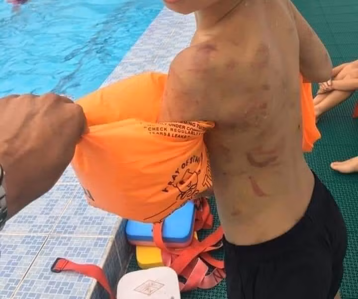 Những vết thương chi chít sau lưng của em Th. do bị ba đánh (Ảnh: CTV) Những vết thương chi chít sau lưng của em Th. do bị ba đánh (Ảnh: CTV)
