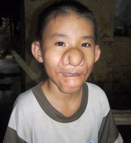 Đó là căn bệnh “trư bát giới”. Cậu bé Bùi Nhật Minh Tiến( sinh năm 2000). Khi mới hai tuổi, trên hai vành tai, đầu, mũi Tiến nổi những mụn nhỏ li ti, càng lớn lên thì những cục mụn này càng to ra khiến cháu rất đau đớn. Những cục u này ngày càng lớn khiến khuôn mặt của cậu bé ngày càng biến dạng. Gia đình khó khăn, vấn đề chạy chữa của cậu bé phụ thuộc vào sự giúp đỡ của những tấm lòng hảo tâm.