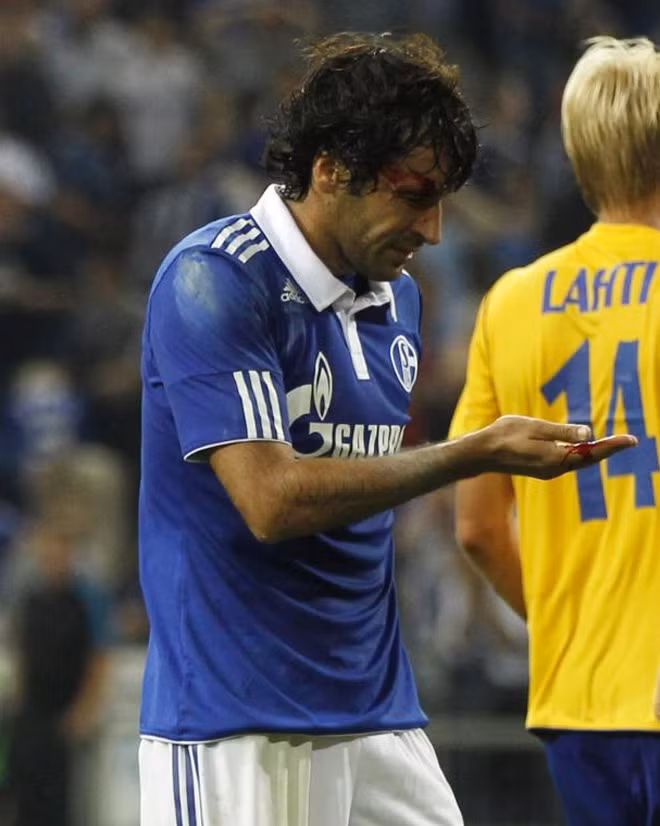 Raul đổ máu trong trận Schalke tiếp HJK Helsinki (Phần Lan) trên sân Gelsenkirchen. Raul đổ máu trong trận Schalke tiếp HJK Helsinki (Phần Lan) trên sân Gelsenkirchen.