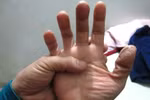 Điều trị bệnh cước bằng những bài thuốc đơn giản