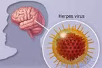 Viêm não virus, phòng bệnh bằng cách nào?