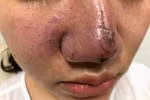 Mù mắt, biến dạng mặt vì tiêm filler trôi nổi, lời cảnh tỉnh cho chị em