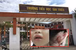 Vụ giáo viên Tiểu học Tân Triều bị tố đánh sưng môi học sinh, cô giáo nói gì