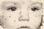Nguyên nhân, triệu chứng và cách điều trị bệnh Rubella