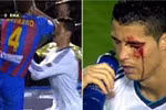 Ronaldo đổ máu vì đòn cùi chỏ