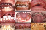 Những sai lầm thường gặp khi mắc bệnh sâu răng