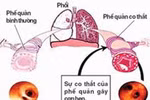 Phương pháp kiểm soát về đề phòng hen phế quản ở trẻ em 