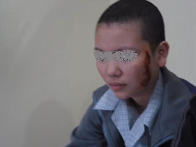Nguyễn Thị G đang được điểu trị tẩy xăm, phục hồi da tại Hà Nội. Nguyễn Thị G đang được điểu trị tẩy xăm, phục hồi da tại Hà Nội.