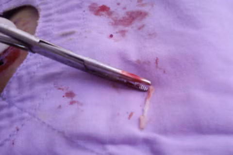 Con sán được phát hiện trong khối u của bệnh nhân. Con sán được phát hiện trong khối u của bệnh nhân.