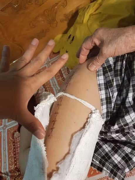 Chân của bé Kiên sau khi được phẫu thuật. ảnh: vtc. Chân của bé Kiên sau khi được phẫu thuật. ảnh: vtc.