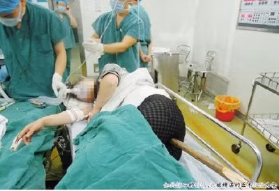 Chị Cao bị chiếc gậy xuyên dọc người khi được đưa đến bệnh viện