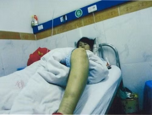 Chị Mai vẫn chưa hết bàng hoàng, sức khỏe và tinh thần đều suy sụp sau vụ cưỡng chế phá thai