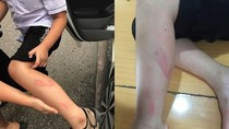 Chân em Đ. bị cô giáo Nguyễn Thị Thu Trang đánh sưng tấy trong giờ kiểm tra học kỳ 2 (Ảnh: Gia đình cung cấp)