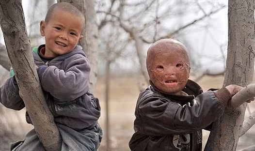 Wang Xiaopeng không có tóc, môi, mí mắt và ngón tay sau tai nạn kinh hoàng.