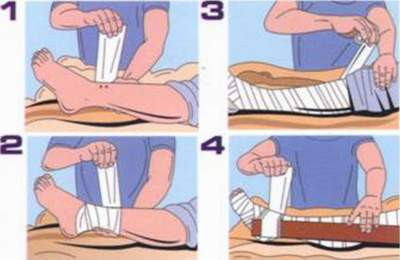 Các thao tác băng bép cố định khi bị rắn độc cắn.