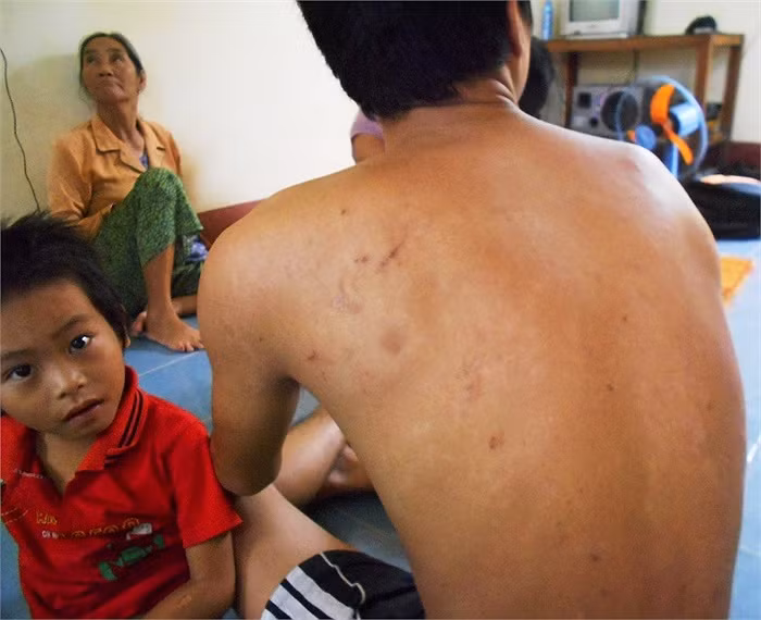 Khắp cơ thể anh Trần Văn Sang con chị Tý đầy rẫy những vết sẹo do côn trùng đốt để lại