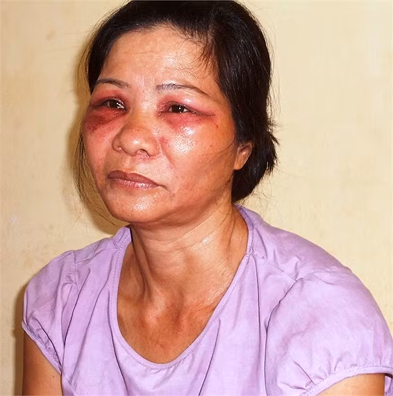 Vùng mắt chị Nguyễn Thị Tý bị sưng húp, đỏ tái, mọng mủ và đau rát do côn trùng lạ cắn