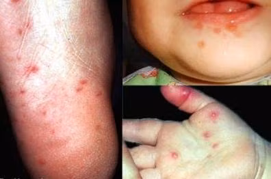 Ban này không ngứa và thường khu trú ở lòng bàn tay hoặc lòng bàn chân. Như vậy ban điển hình thường xuất hiện ở các vị trí tay, chân và miệng nên bệnh có tên Bệnh Tay – Chân - Miệng.