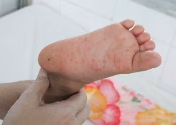 Biểu hiện đặc trưng của bệnh bởi sốt, đau họng và nổi ban có bọng nước. Triệu chứng đầu tiên thường là sốt nhẹ, biếng ăn, mệt mỏi và đau họng. Một đến hai ngày sau khi xuất hiện sốt trẻ bắt đầu đau miệng.