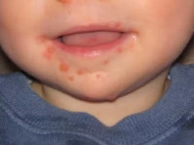 Bệnh tay, chân và miệng (TCM) là một hội chứng bệnh ở người do virus đường ruột của họ Picornaviridae gây ra. Giống vi rút gây bệnh TCM phổ biến nhất là Coxsackie A và virus Enterovirus 71 (EV-71). Đây là một bệnh thường gặp ở nhũ nhi và trẻ em.