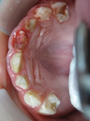 Nếu bạn bị sâu răng, bạn sẽ biết ngay? Đó là một hiểu lầm tai hại. Ở giai đoạn đầu của sâu răng thì sẽ không có biểu hiện triệu chứng gì. Đến khi bạn cảm nhận được nỗi đau của những chỗ sâu răng gây ra thì lúc đó sâu răng đã ở mức độ nặng và gây tổn hại dây thần kinh rất nhiều rồi. Vậy nên hãy thường xuyên tự kiểm tra răng để phát hiện sớm các bệnh ở răng miệng.