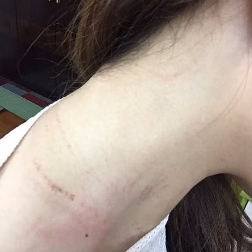 Vết trầy xước trên cổ của nữ nhân viên Nguyễn Lê Quỳnh Anh sau khi bị hành hung. ảnh: Pháp luật Việt Nam. Vết trầy xước trên cổ của nữ nhân viên Nguyễn Lê Quỳnh Anh sau khi bị hành hung. ảnh: Pháp luật Việt Nam.