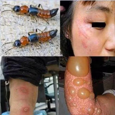 Tác hại khi bị kiến ba khoang tiết dịch lên da