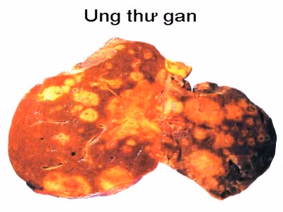 8. Ung thư gan và ống mật trong gan: Ung thư gan là một trong những bệnh ung thư phổ biến nhất trên thế giới, nhưng không hay gặp ở Mỹ. Tuy nhiên, tỷ lệ ung thư gan ở Mỹ đang gia tăng. Phần lớn ung thư gan xuất hiện ở Mỹ bắt nguồn từ vị trí khác sau đó di căn tới gan. Loại ung thư tương đối gần là ung thư ống mật trong gan, xuất hiện trong ống dẫn mật từ gan tới ruột non. Theo NCI, nam 2010 có gần 19.000 người Mỹ tử vong vì ung thư gan và ống mật trong gan.