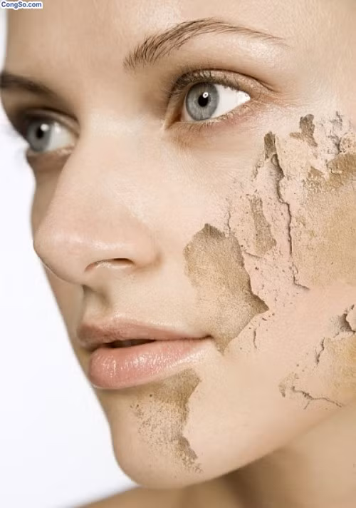 Mụn, da lở loét và ngứa ngáy, lở loét tại các vết thương mở , vết bỏng …đều là những triệu chứng của bệnh ung thư da.