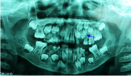 Hình ảnh X-Quang cho thấy túi răng nằm trong miệng bệnh nhi