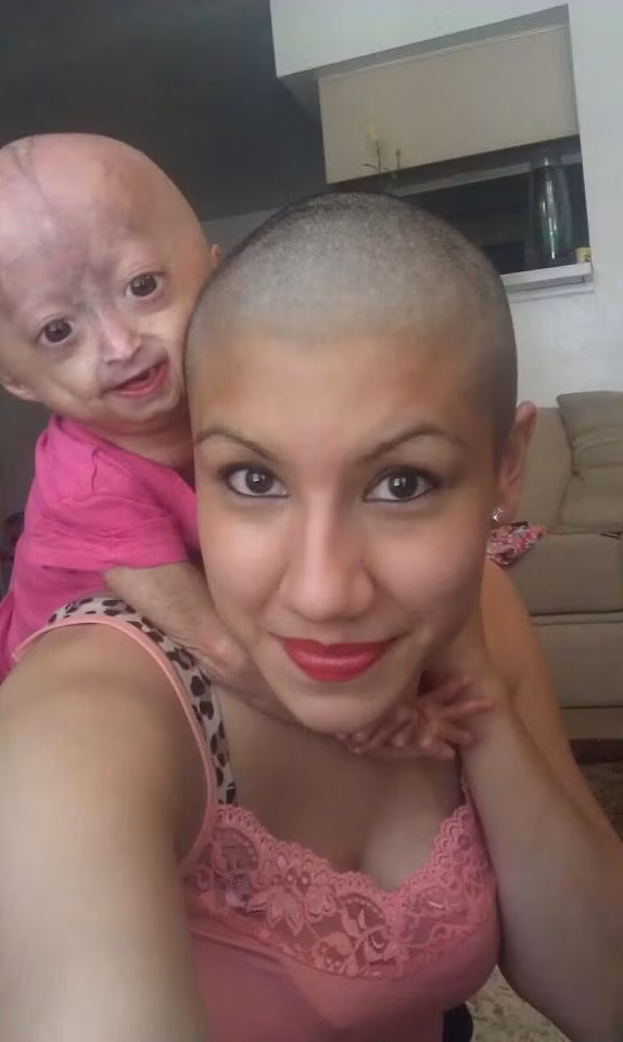 Mới chỉ 5 tuổi nhưng Adalia Rose có khuôn mặt và hình dáng của một bà già. Không hề mặc cảm với ngoại hình, cô bé vẫn sống rất vui vẻ bên gia đình và bạn bè. Bức ảnh cô chụp bên mẹ mình đang nhận được 2 triệu like. Mới chỉ 5 tuổi nhưng Adalia Rose có khuôn mặt và hình dáng của một bà già. Không hề mặc cảm với ngoại hình, cô bé vẫn sống rất vui vẻ bên gia đình và bạn bè. Bức ảnh cô chụp bên mẹ mình đang nhận được 2 triệu like.