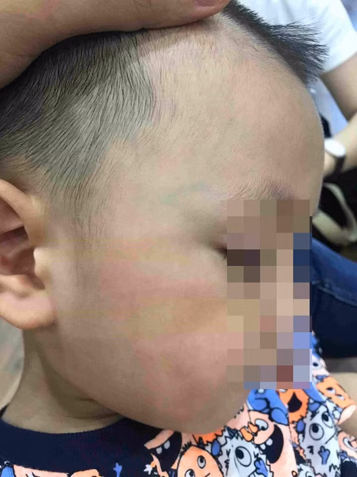 Má bé có vết đỏ. Ảnh gia đình cung cấp