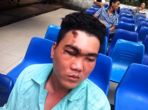 Anh Lê Thanh Hải có nguy cơ bị mù mắt phải sau vụ tai nạn này (ảnh: H.L) Anh Lê Thanh Hải có nguy cơ bị mù mắt phải sau vụ tai nạn này (ảnh: H.L)