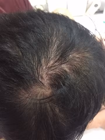 Những vết thương trên đầu của anh Toàn. Những vết thương trên đầu của anh Toàn.