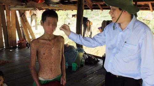"Bệnh lạ" Quảng Ngãi: Nghi do gạo mốc, Tin tức trong ngày, benh la o quang ngai, benh la, day sung long ban tay ban chan, benh day sung, viem da long ban tay ban chan, benh viem da, benh la gay tu vong, bao, tin hay, tin hot, tin tuc