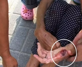 Bàn tay bật máu