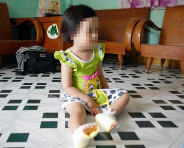 Cháu bé N.C.A bị bỏng vì bị bảo mẫu phạt