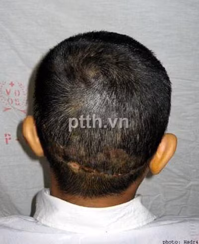 Sau khi nối da đầu, tóc bệnh nhân đã mọc lại. Ảnh do Khoa Phẫu thuật Tạo hình - Hàm mặt Bệnh viện Việt Đức cung cấp Sau khi nối da đầu, tóc bệnh nhân đã mọc lại. Ảnh do Khoa Phẫu thuật Tạo hình - Hàm mặt Bệnh viện Việt Đức cung cấp