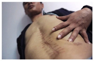 Sẹo sau mổ trên cơ thể Lưu Dũng, người cáo buộc mình bị bác sĩ tự ý cắt mất thận trái Sẹo sau mổ trên cơ thể Lưu Dũng, người cáo buộc mình bị bác sĩ tự ý cắt mất thận trái