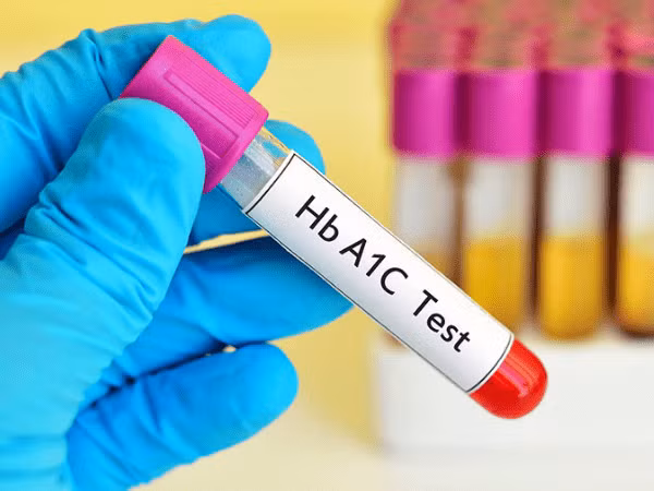 Xét nghiệm A1C đã trở nên quan trọng trong việc theo dõi bệnh tiểu đường (Ảnh: theo boldsky). Xét nghiệm A1C đã trở nên quan trọng trong việc theo dõi bệnh tiểu đường (Ảnh: theo boldsky).